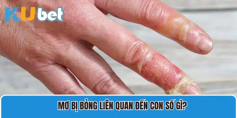 Mơ bị bỏng và các con số liên quan bạn cần nắm
